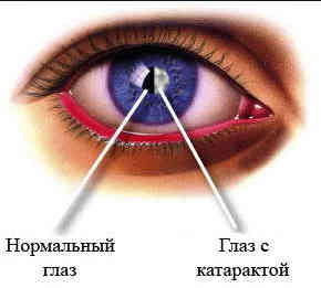 катаракта, зрение